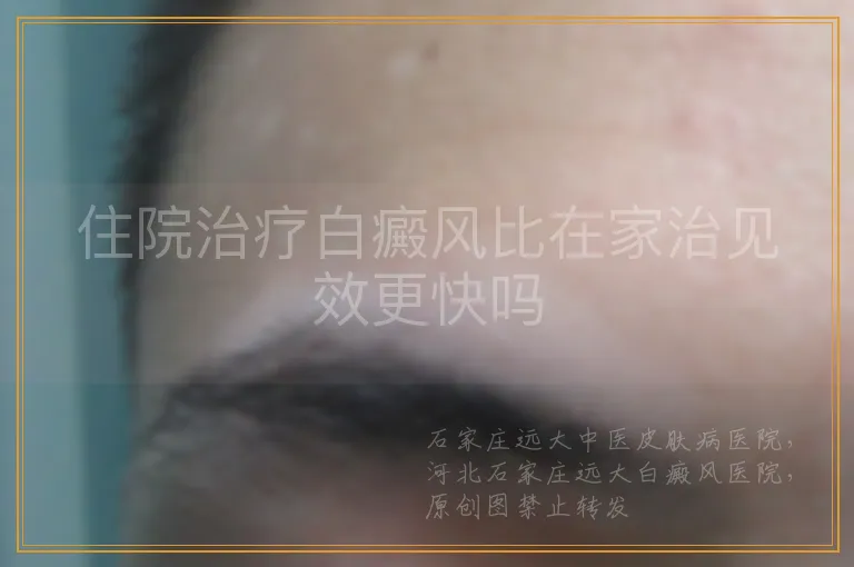 住院治疗白癜风比在家治见效更快吗