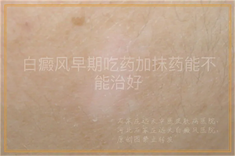 白癜风早期吃药加抹药能不能治好