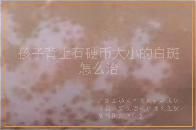 孩子背上有硬币大小的白斑怎么治