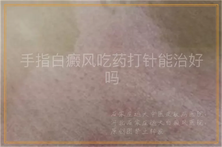 手指白癜风吃药打针能治好吗