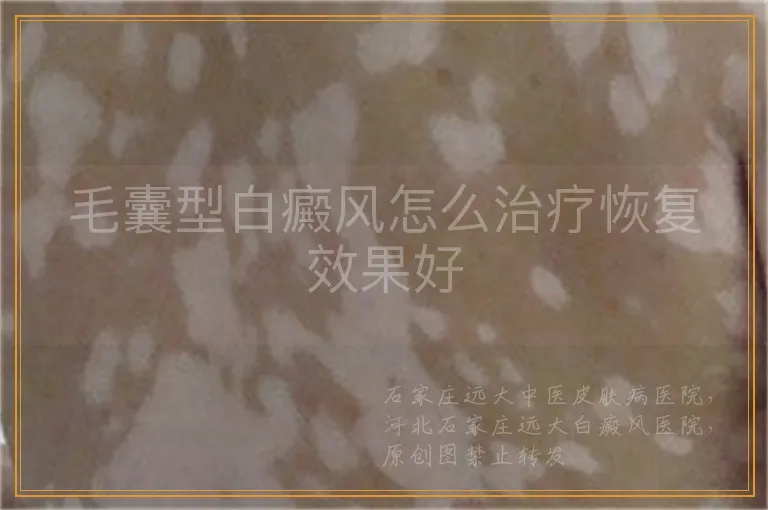 毛囊型白癜风怎么治疗恢复效果好
