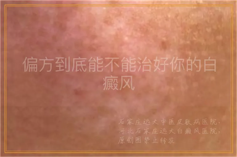 偏方到底能不能治好你的白癜风