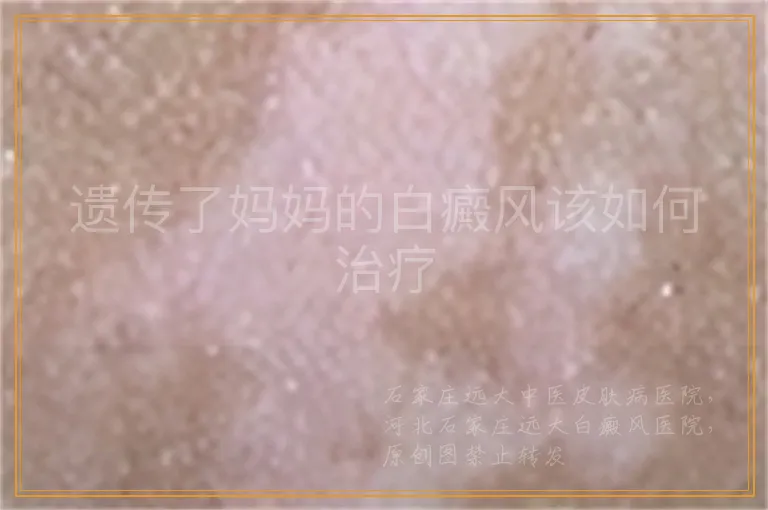 遗传了妈妈的白癜风该如何治疗