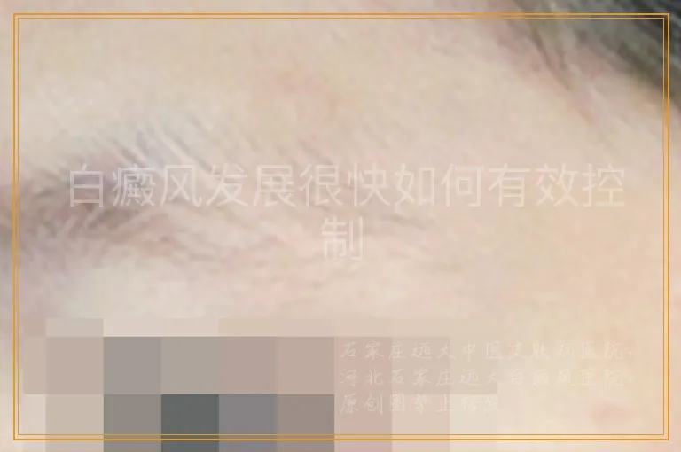 白癜风发展很快如何有效控制