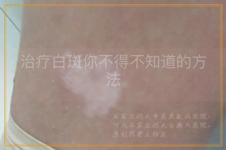 治疗白斑你不得不知道的方法