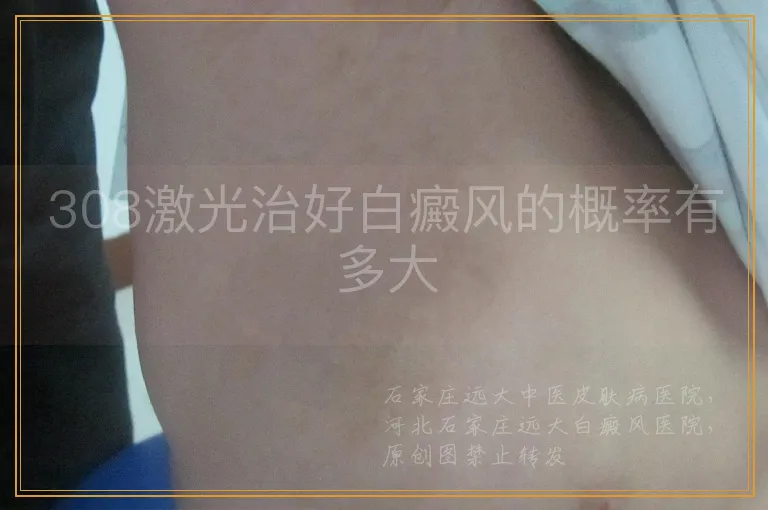 308激光治好白癜风的概率有多大