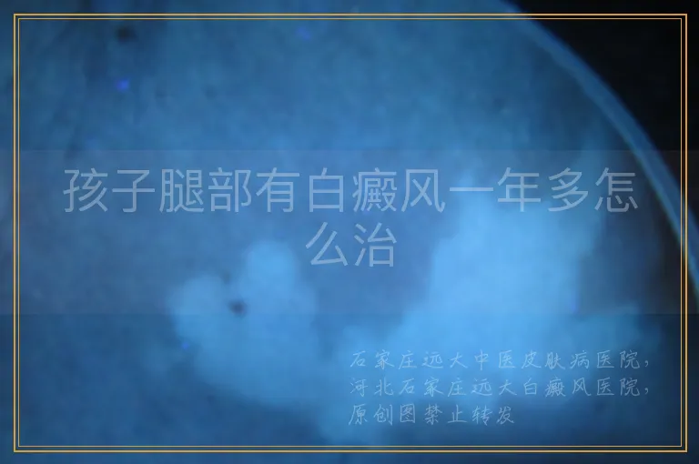 孩子腿部有白癜风一年多怎么治