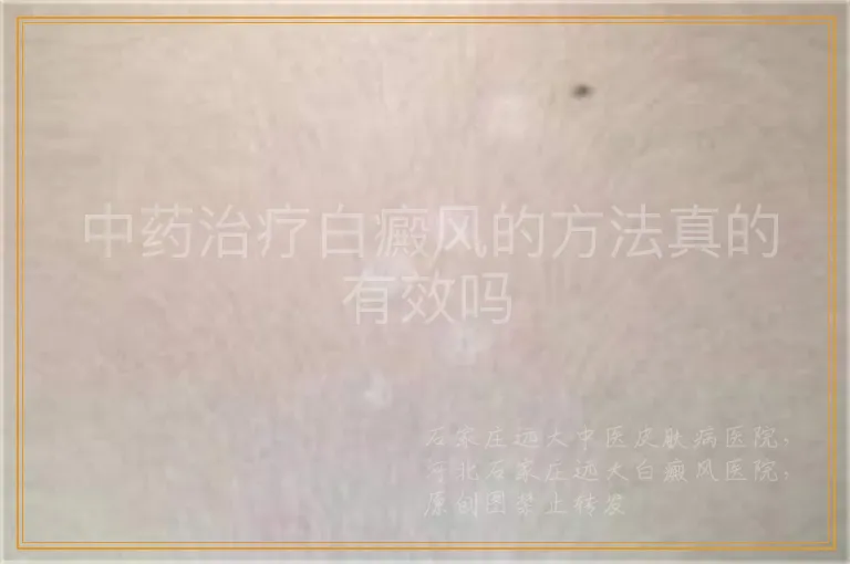 中药治疗白癜风的方法真的有效吗
