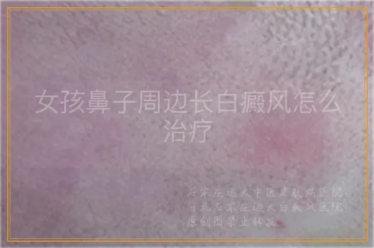 女孩鼻子周边长白癜风怎么治疗
