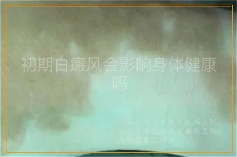 初期白癜风会影响身体健康吗