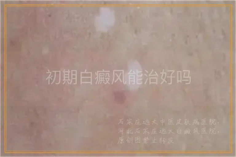 初期白癜风能治好吗