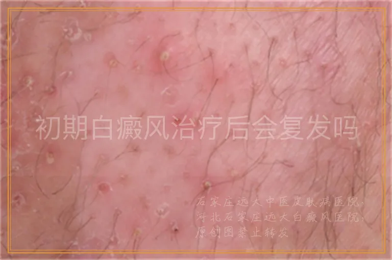 初期白癜风治疗后会复发吗