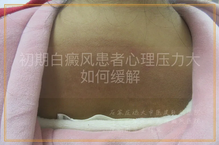 初期白癜风患者心理压力大如何缓解