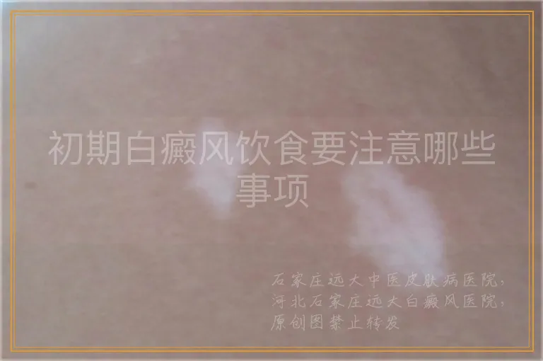 初期白癜风饮食要注意哪些事项