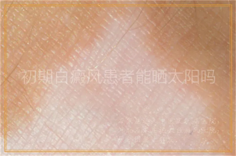 初期白癜风患者能晒太阳吗