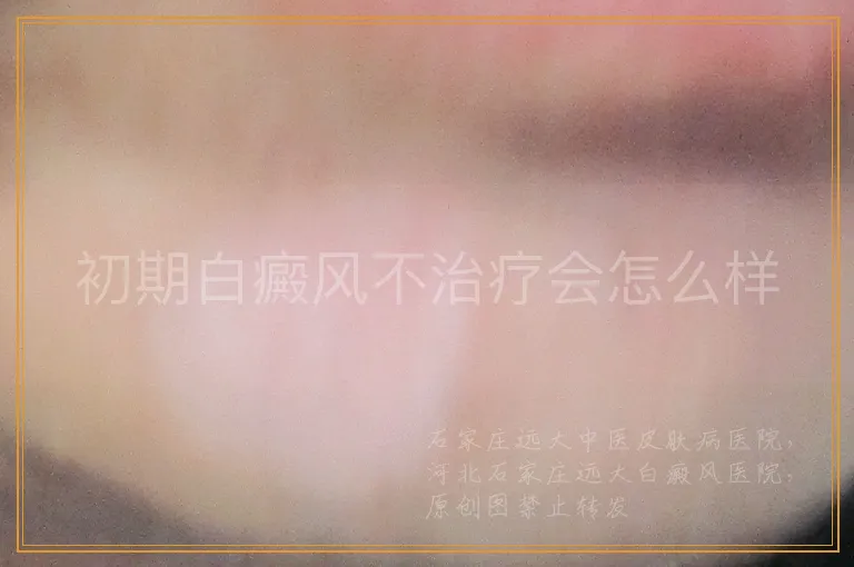 初期白癜风不治疗会怎么样