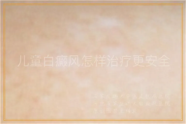 儿童白癜风怎样治疗更安全