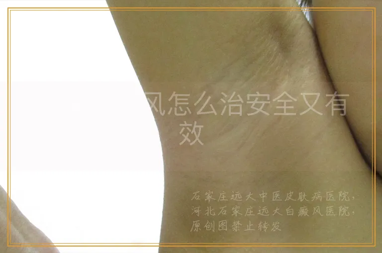 儿童白癜风怎么治安全又有效