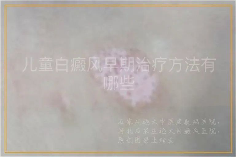 儿童白癜风早期治疗方法有哪些