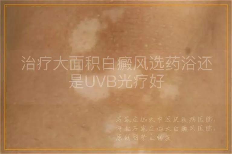 治疗大面积白癜风选药浴还是UVB光疗好