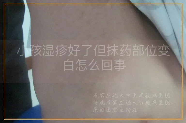 小孩湿疹好了但抹药部位变白怎么回事