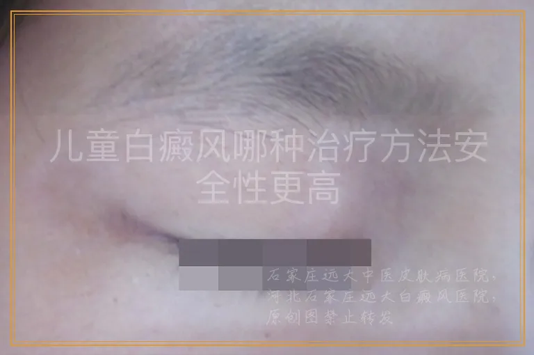 儿童白癜风哪种治疗方法安全性更高
