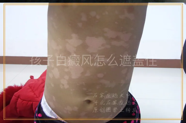 孩子白癜风怎么遮盖住
