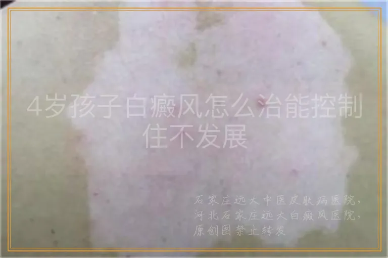 4岁孩子白癜风怎么治能控制住不发展