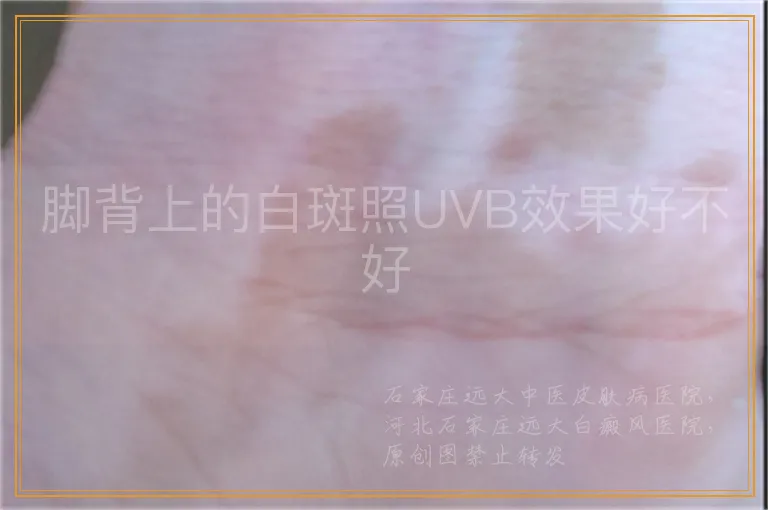 脚背上的白斑照UVB效果好不好