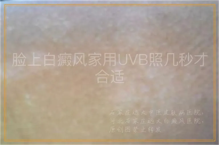 脸上白癜风家用UVB照几秒才合适