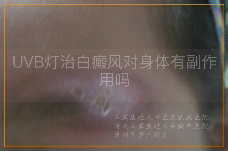 UVB灯治白癜风对身体有副作用吗