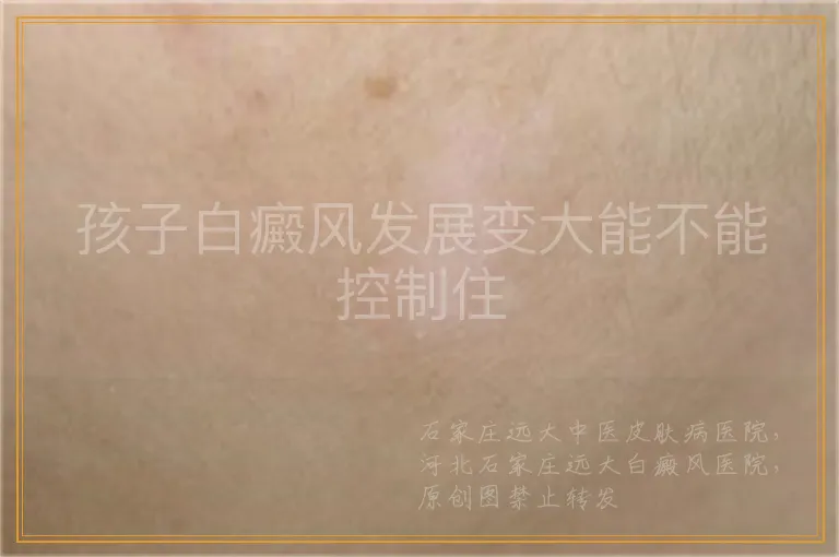 孩子白癜风发展变大能不能控制住
