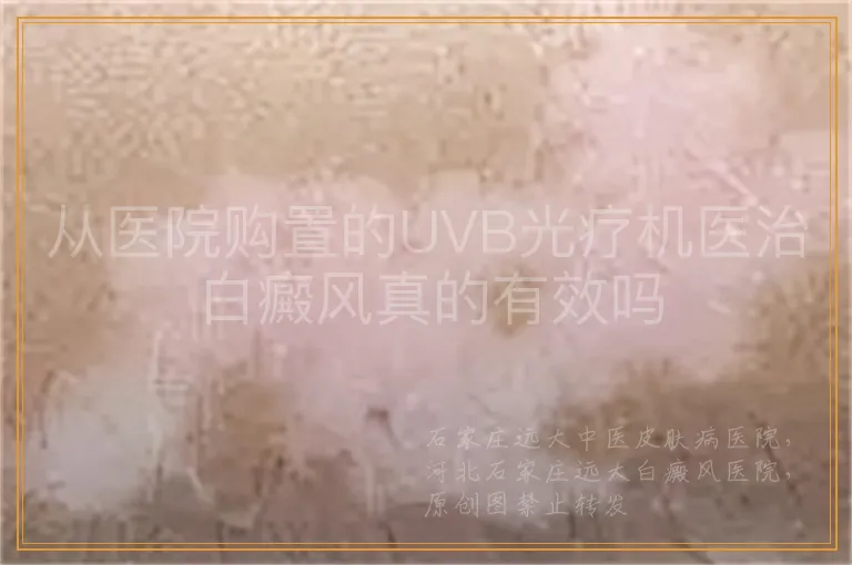 从医院购置的UVB光疗机医治白癜风真的有效吗
