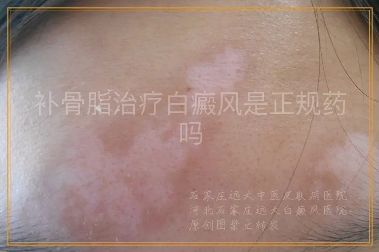 补骨脂治疗白癜风是正规药吗