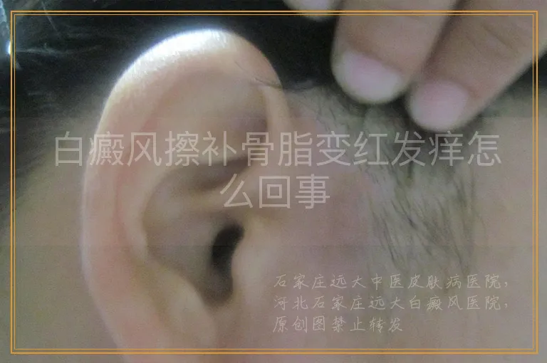 白癜风擦补骨脂变红发痒怎么回事