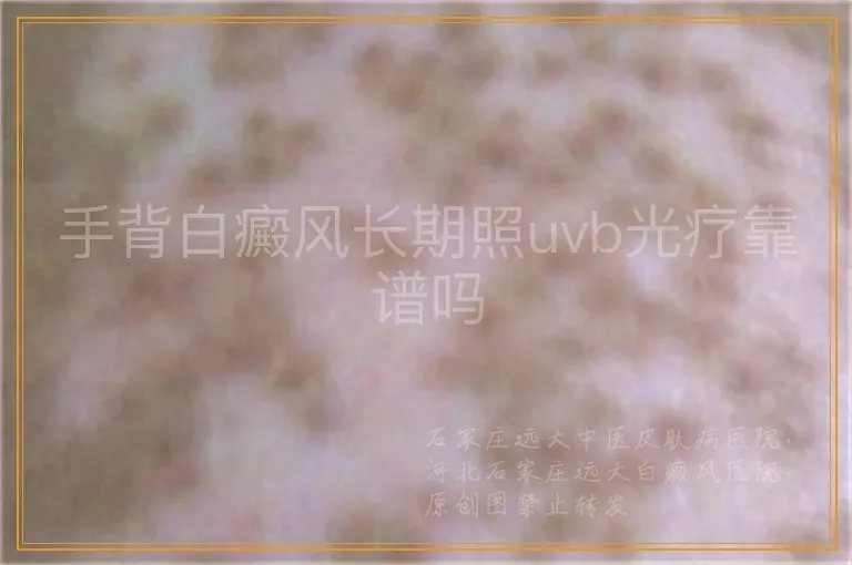 手背白癜风长期照uvb光疗靠谱吗