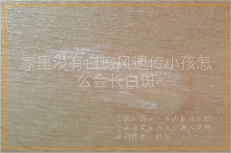 家里没有白癜风遗传小孩怎么会长白斑