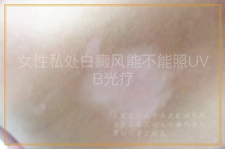 女性私处白癜风能不能照UVB光疗