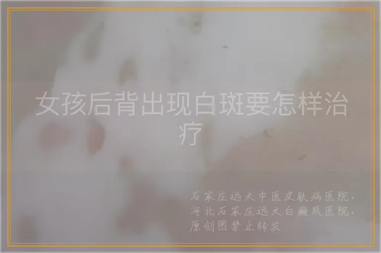女孩后背出现白斑要怎样治疗