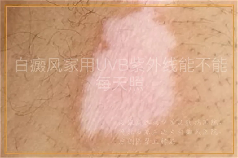 白癜风家用UVB紫外线能不能每天照