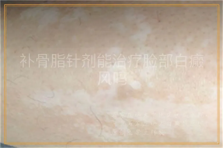 补骨脂针剂能治疗脸部白癜风吗