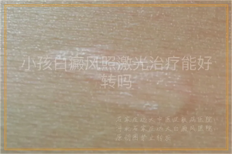 小孩白癜风照激光治疗能好转吗