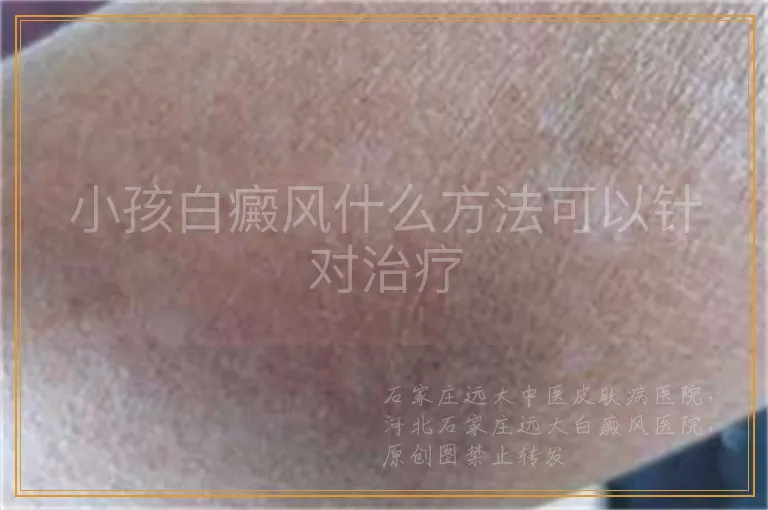 小孩白癜风什么方法可以针对治疗