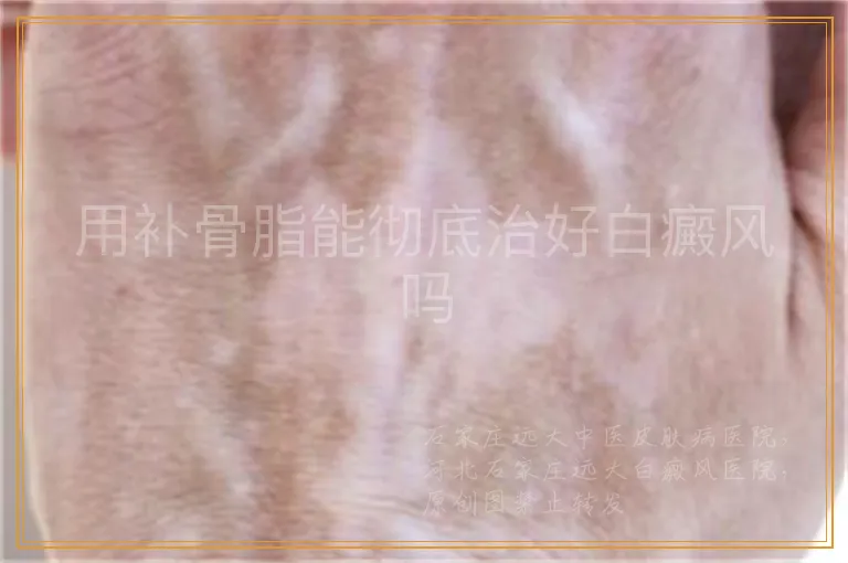 用补骨脂能彻底治好白癜风吗