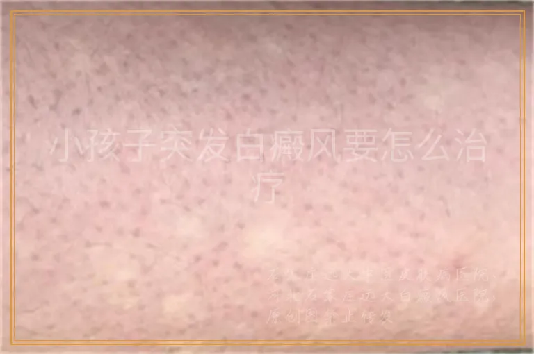 小孩子突发白癜风要怎么治疗