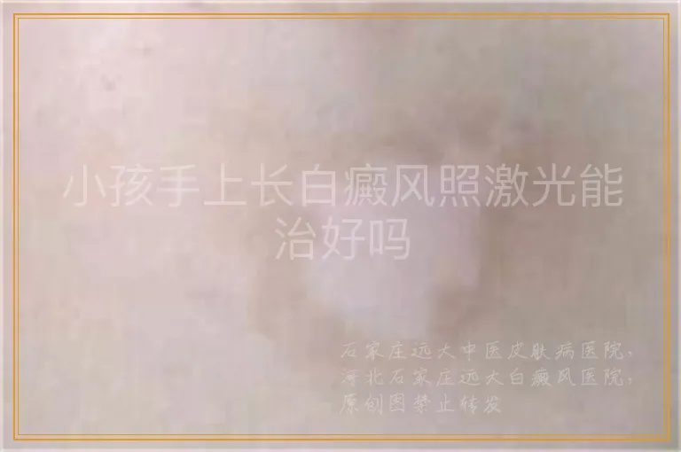 小孩手上长白癜风照激光能治好吗