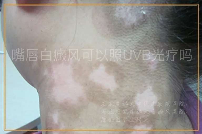 嘴唇白癜风可以照UVB光疗吗
