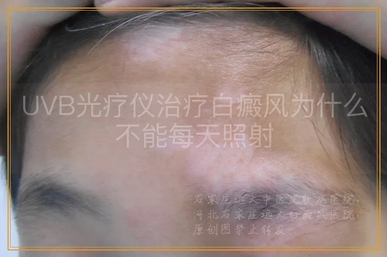 UVB光疗仪治疗白癜风为什么不能每天照射