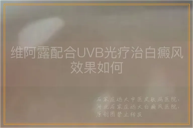 维阿露配合UVB光疗治白癜风效果如何