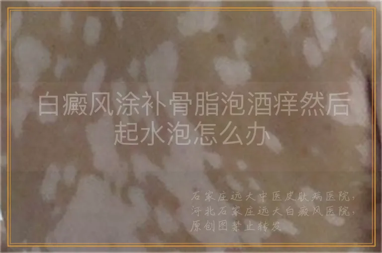 白癜风涂补骨脂泡酒痒然后起水泡怎么办